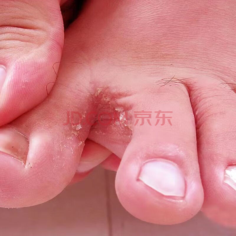 老津医脚气喷雾剂痒膏脚脱皮烂l脚丫真菌感染去l脚臭脚气汗脚锐皮水泡 喷剂+乳膏，