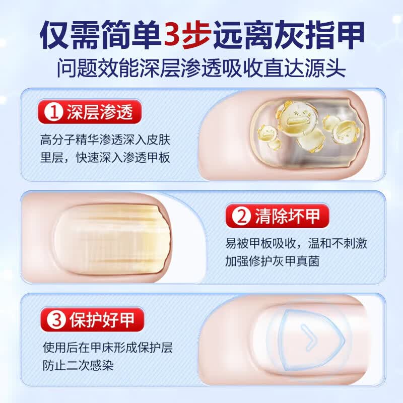 国药药材重度灰指甲100%特效专用的药特殊效专用抑菌液灰甲净套装 五盒装【去灰甲不返复】 灰指甲100%特效专用的药