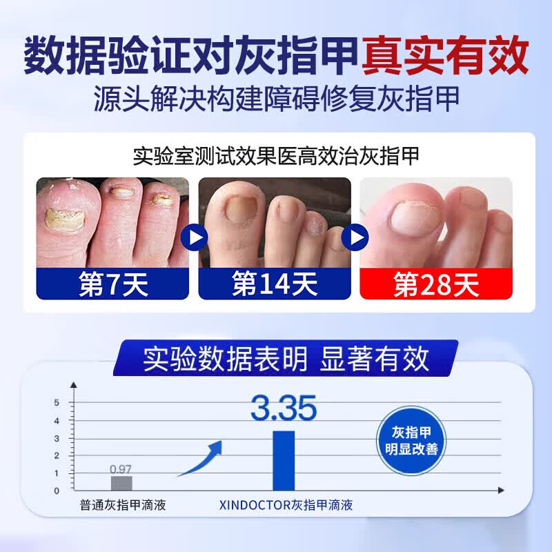 国药药材重度灰指甲100%特效专用的药特殊效专用抑菌液灰甲净套装 五盒装【去灰甲不返复】 灰指甲100%特效专用的药
