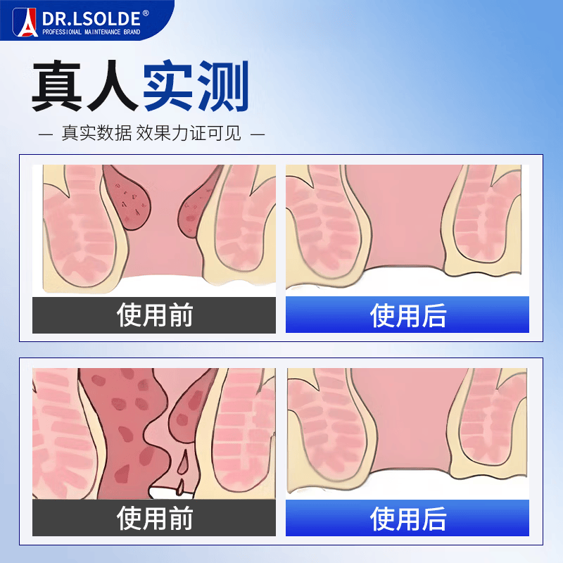 痔疮凝胶内外混合痔肉球脱落肛门瘙痒便血疼痛红肿肛裂 1盒装 【稳固装】 【官方直售 京质保障】