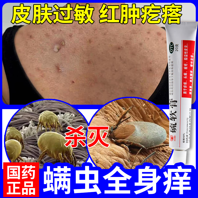 螨虫皮肤用药】螨虫性皮炎除螨去螨虫后背长痘祛痘红斑丘疹肿胀皮肤