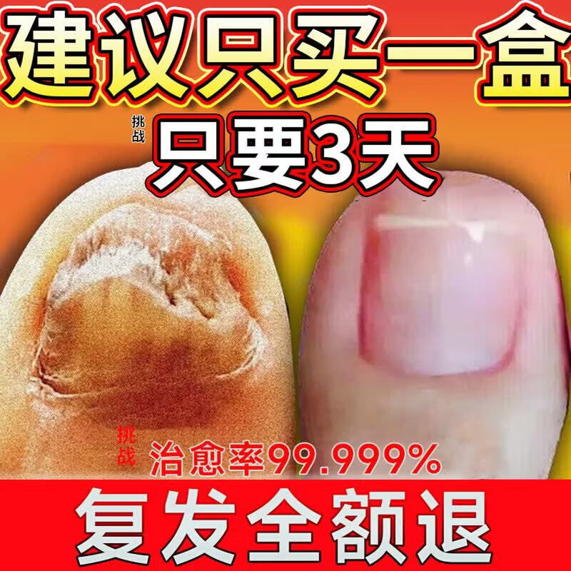 国药药材重度灰指甲100%特效专用的药特殊效专用抑菌液灰甲净套装 五盒装【去灰甲不返复】 灰指甲100%特效专用的药