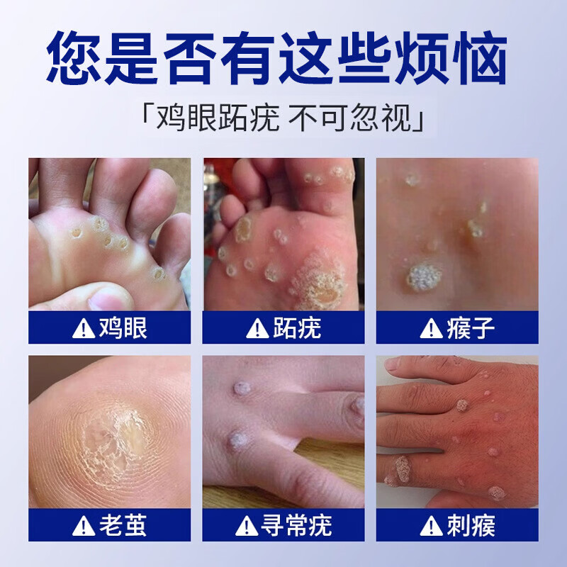 水杨酸去疣贴高浓度去苯扁酚平疣跖瘊子除足部脚底老茧肉刺 1盒【见效装】 【品牌直售】