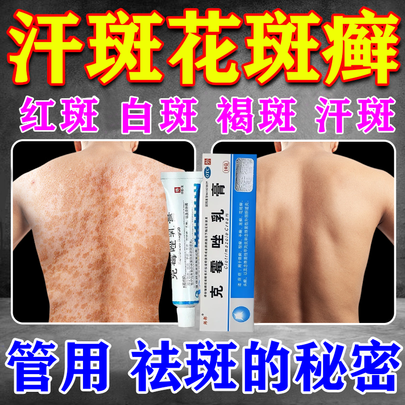 汗斑专用药膏花斑癣专用药除平方根药膏去汗斑的药膏治疗成人儿童汗斑