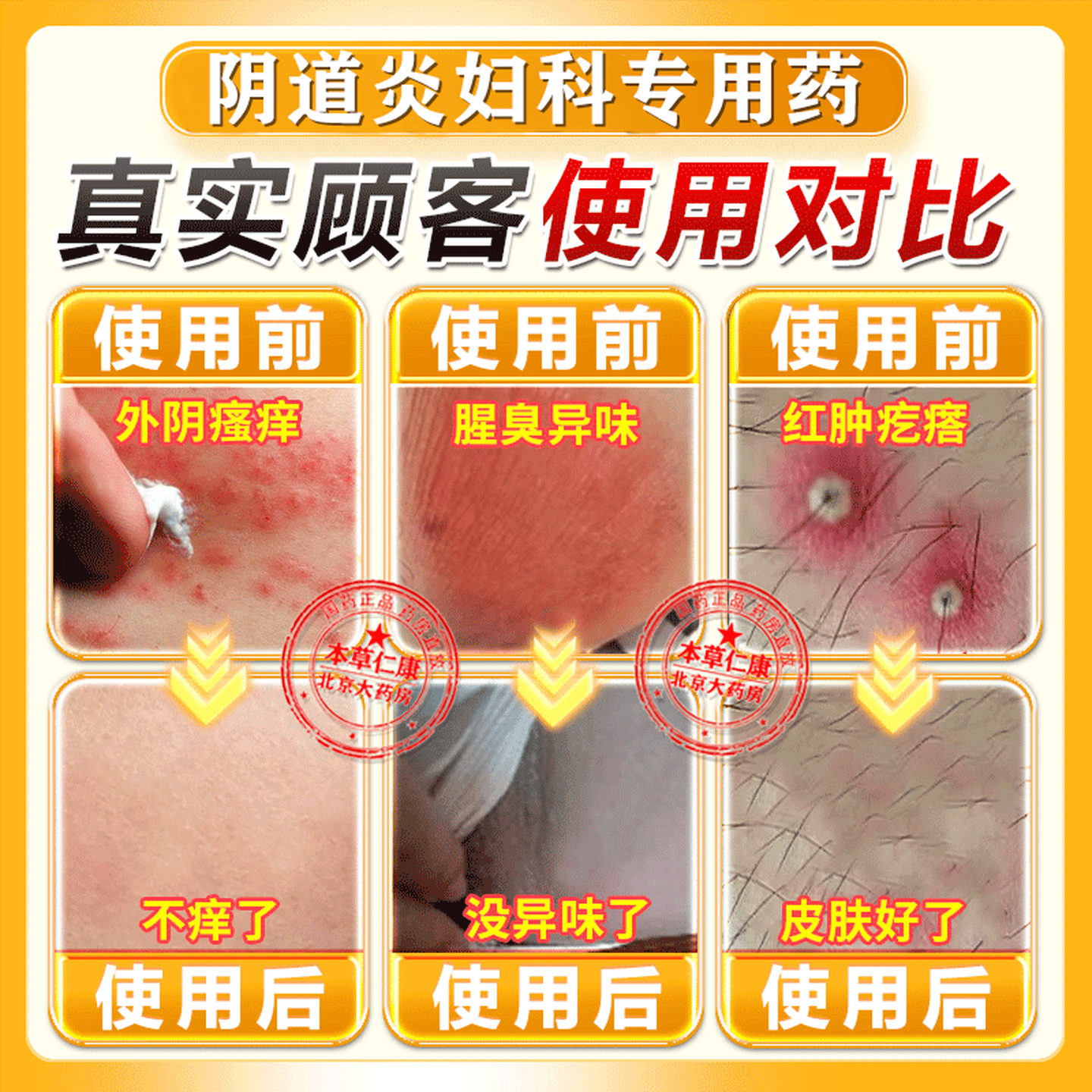 [恒久远]克霉唑乳膏 外阴瘙痒妇科专用私处止痒杀菌药膏 妇科炎症外阴道瘙痒消炎专用妇科用药 非处方药 10g 5盒装 【严重妇科炎症】