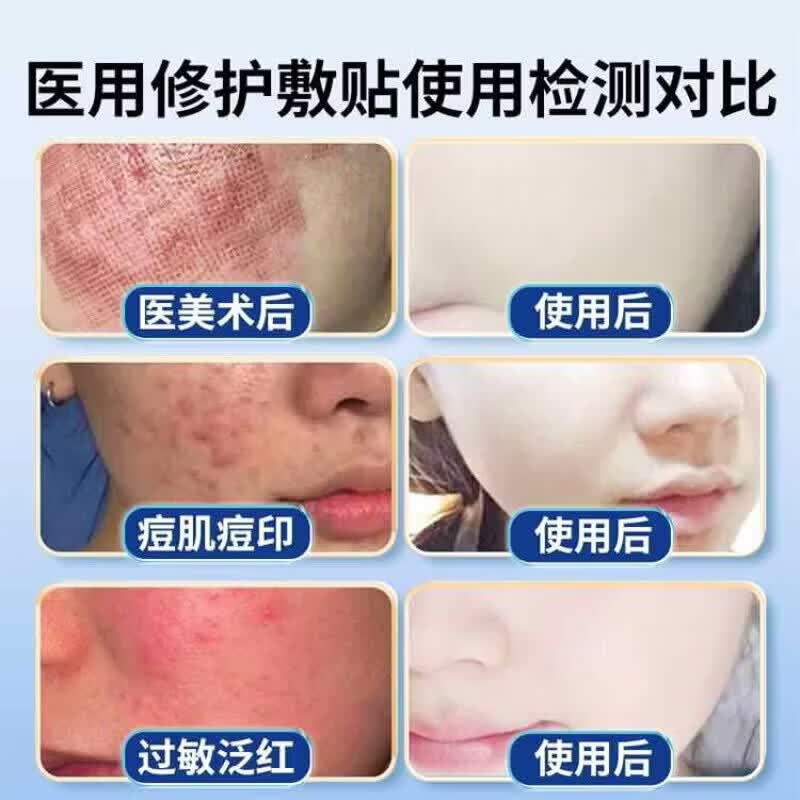 可优比(KUB)修复贴舒缓肌肤破损创面修护泛红破皮淡化伤口红印隔离外界刺激加 1盒 【见效装】 【品牌直售】