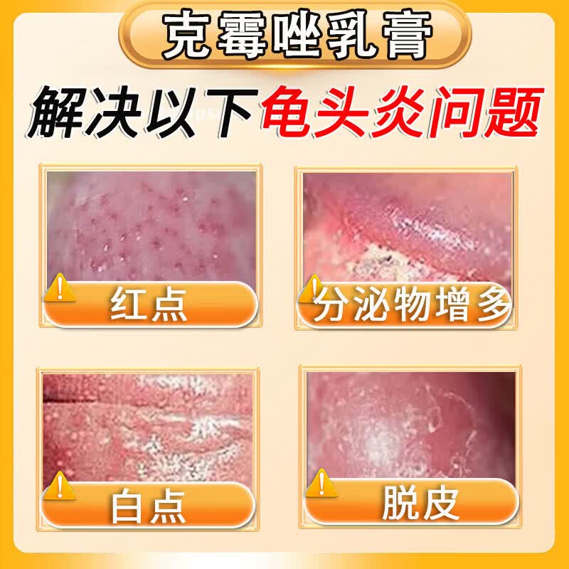 [川石]克霉唑乳膏 男性真菌感染龟头炎白垢豆腐渣男士专用膏药红肿瘙痒丘疹红点白点念珠菌性霉菌男科用药 1%*10g 1盒装 【快速缓解私处瘙痒红肿】