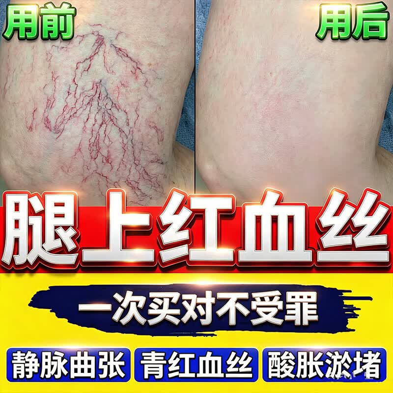 葵花腿上红血丝去除静脉曲张专用膏血管堵塞疏通药膏修复角质层腿上红 【单盒】 1个*1盒 【涂抹型】 京东折扣/优惠券