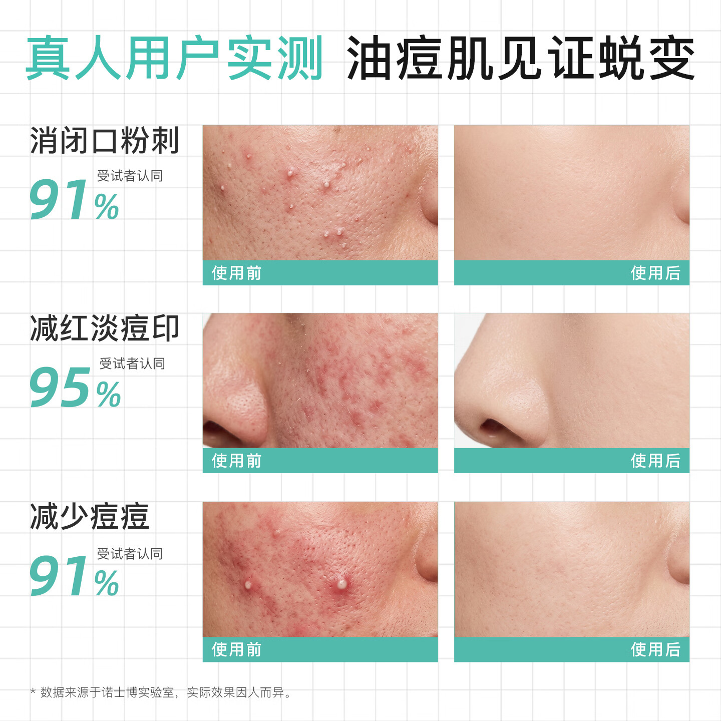 诺士博（NOVEXPERT）法国进口青少年祛痘面霜壬二酸控油去黑头粉刺淡痘印痤疮男女30ml 【采销直播间】青少年壬二酸祛痘面霜30ml