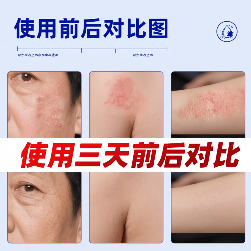 新适确得卤i米松三i氯生乳膏适用于脂溢性皮炎痒湿湿疹神经性皮炎抑菌止痒 两支疗程装 【正品直售 京质保障】