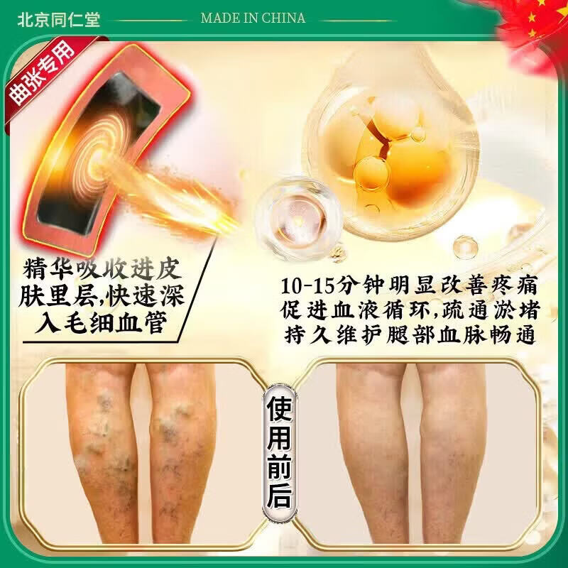 北京协和医学院静脉曲张专用膏药蚯蚓腿疏通血管堵塞进口药冷敷凝胶治疗静脉舒膏 一盒【北京同仁堂】新品限时优惠 特效静脉曲张喷雾专用贴的