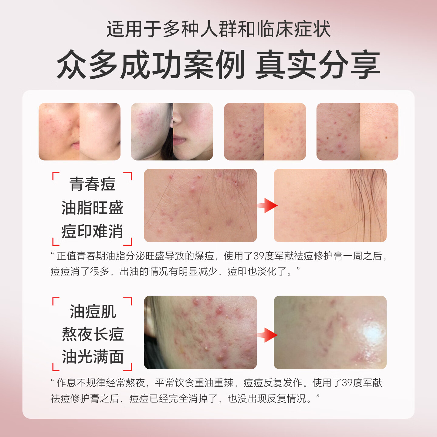 39度JUNXIAN祛痘修护膏精华水杨酸淡化痘印去黑头青春痘闭口祛痘礼物 三支装 (重度痘肌 抑痘不反复)