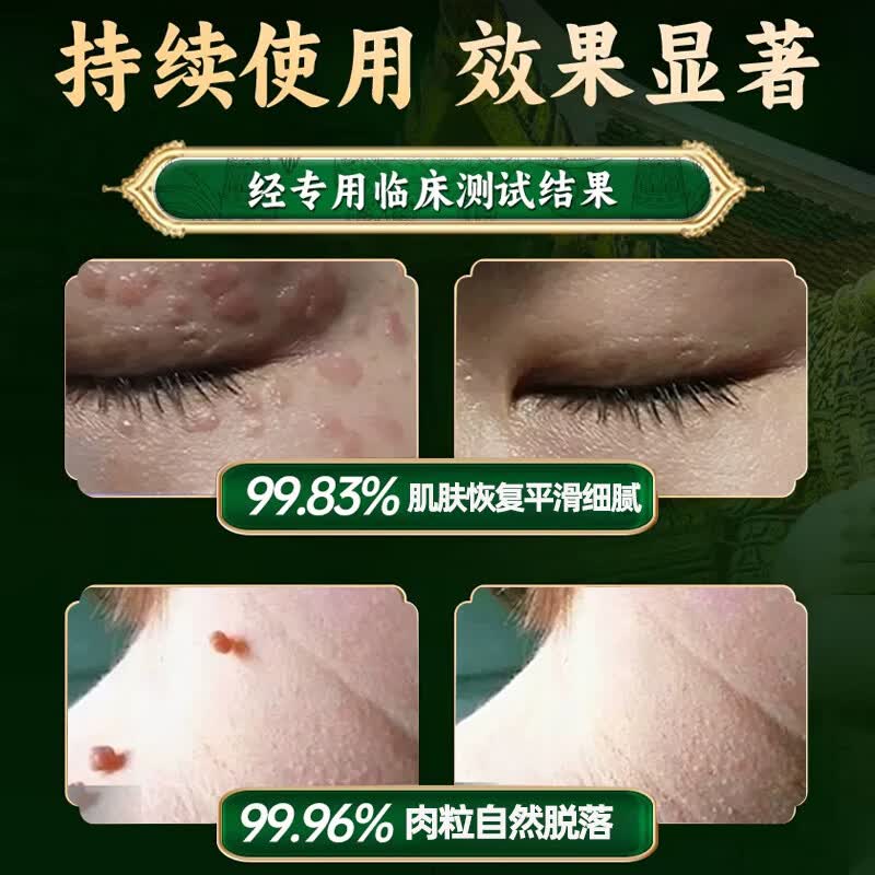 泰国清优灵祛疣膏脖子上小肉粒清疣灵疣体脱落膏丝状扁平肉粒全身适用 【疣不再来】1盒 50g 1盒 1