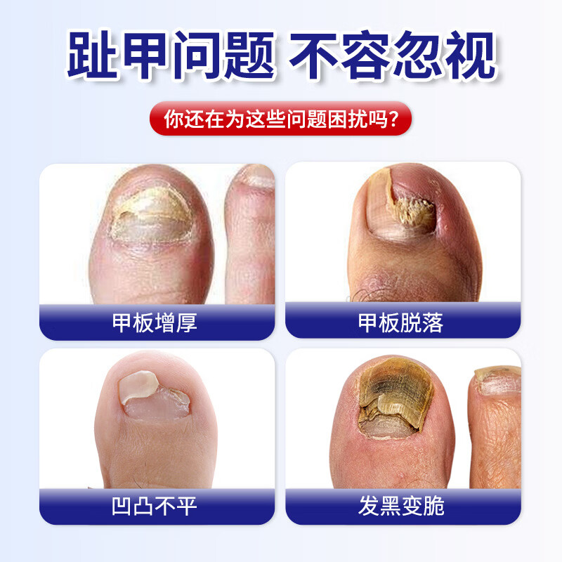 凤仙花官方旗舰店凤仙花灰指甲外用灰甲贴套装保健温和吸收草本精华 清爽舒适【50g*2+50g】