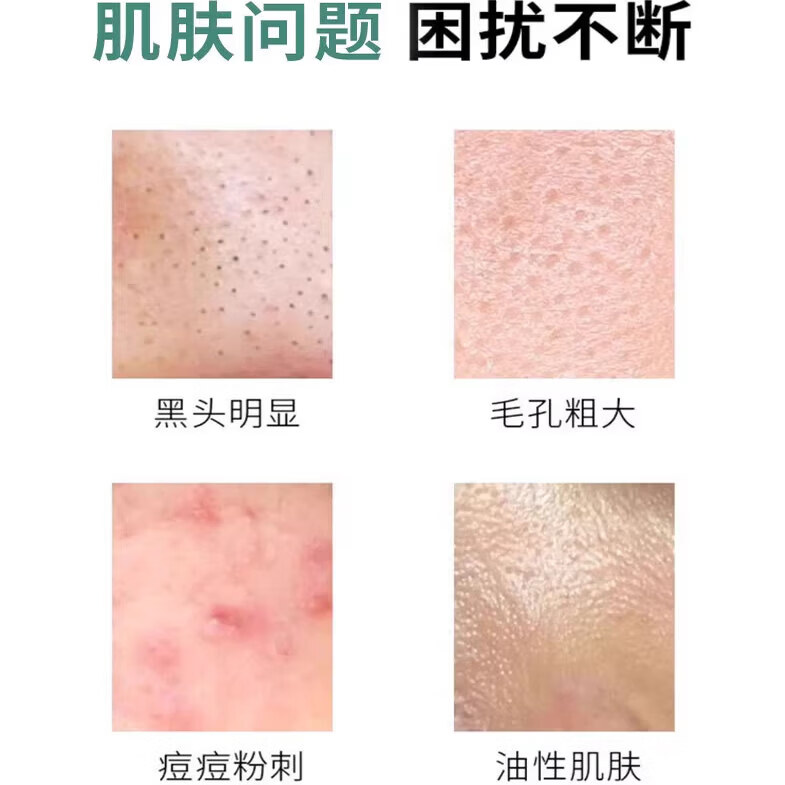 积雪苷药膏复颜舒缓膏苷霜软霜黑色素沉淀痘印修淡化祛 1支 【基础装】20g