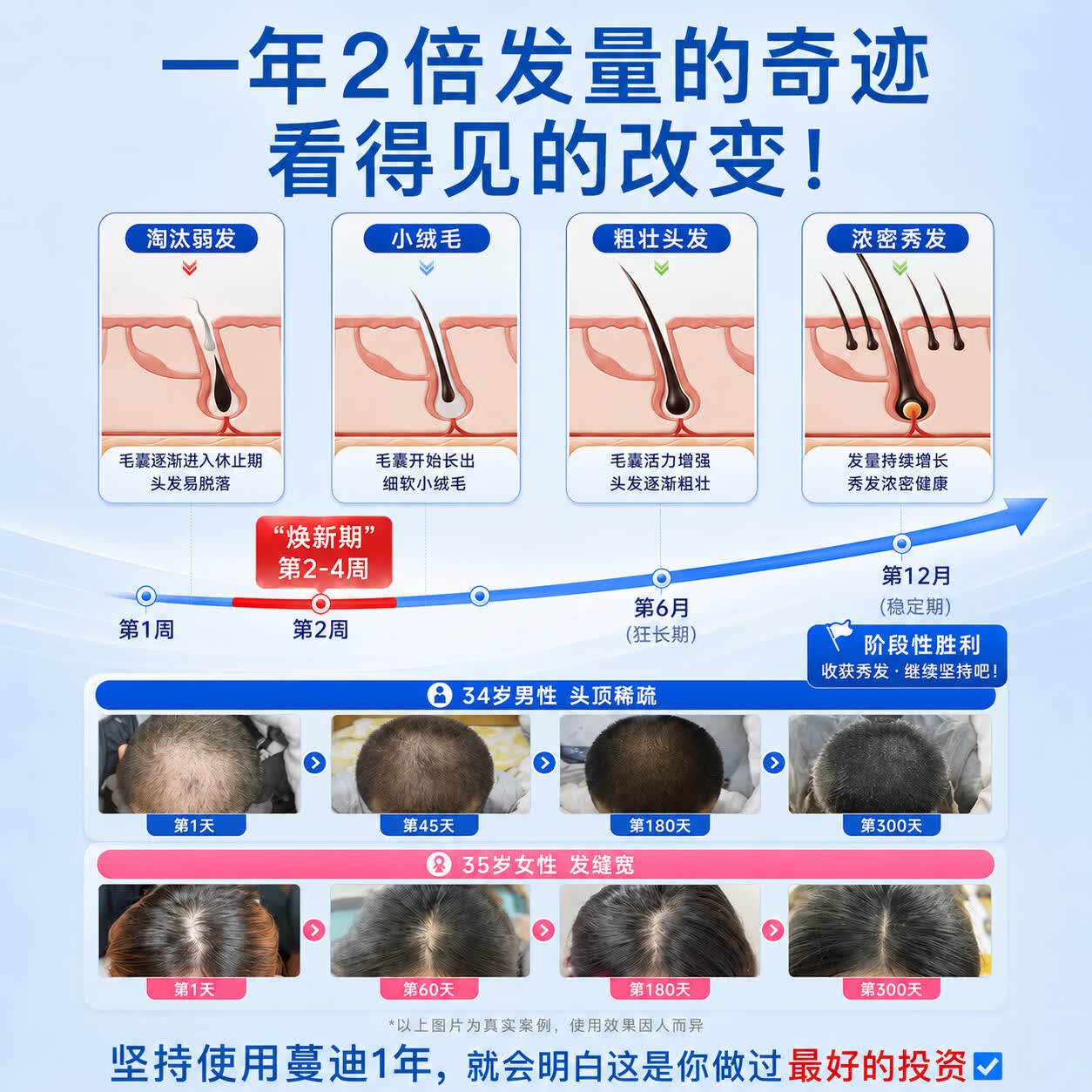 [蔓迪]米诺地尔泡沫剂 60g*3瓶 1盒装 【独家获批】5%*60g 米诺地尔第二代 防脱育发液(0丙二醇低敏少痘） 推荐-店铺礼包款