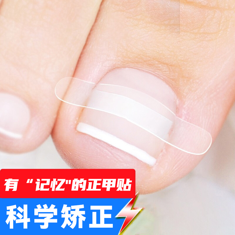 aseblarm嵌甲矫正正甲贴脚趾甲贴片指甲长肉里专用拉拉脚沟足贴 (轻度