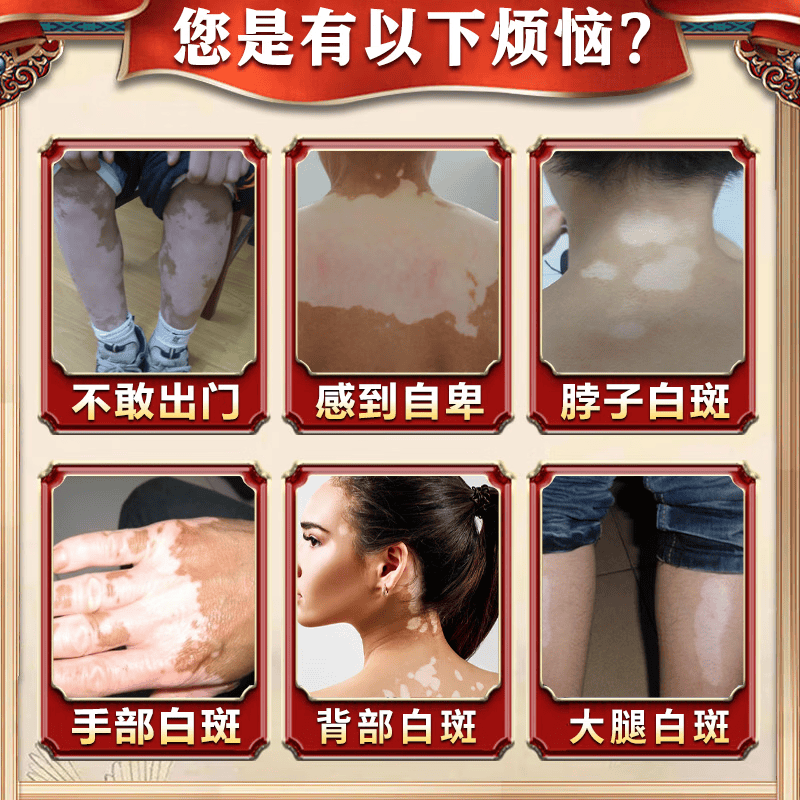 岩井昃弘日本进口白癜风药膏外用促进黑色素生长修复白癜风遮盖液专用神器 特效一盒装【美国进口】 医外用软补骨脂酊神器黑色素生长