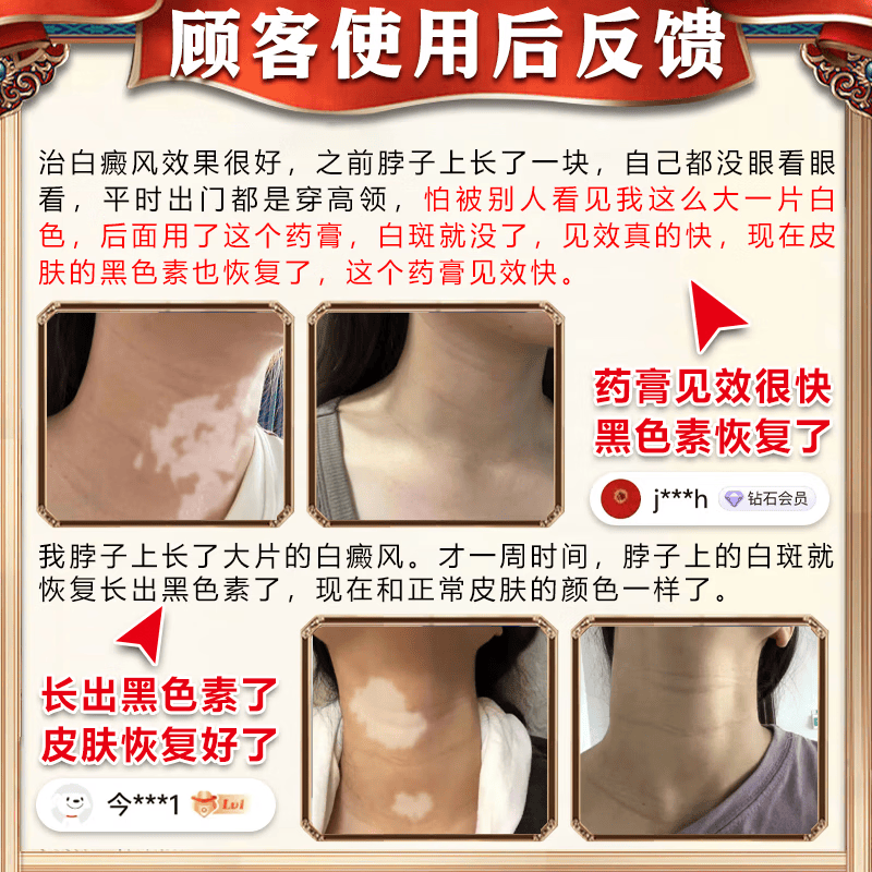 岩井昃弘日本进口白癜风药膏外用促进黑色素生长修复白癜风遮盖液专用神器 特效一盒装【美国进口】 医外用软补骨脂酊神器黑色素生长