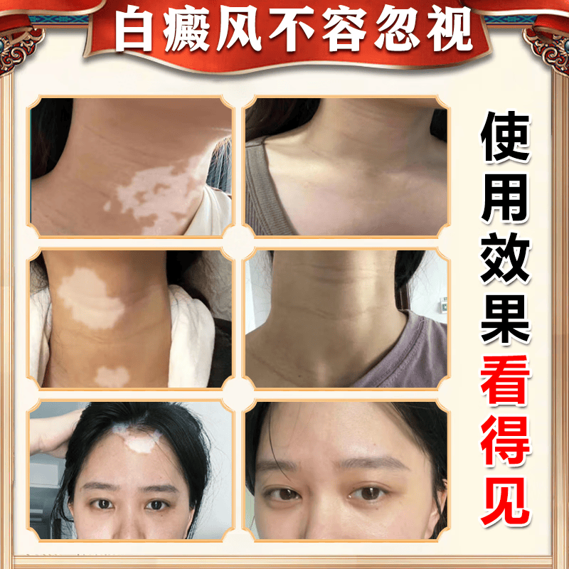 岩井昃弘日本进口白癜风药膏外用促进黑色素生长修复白癜风遮盖液专用神器 特效一盒装【美国进口】 医外用软补骨脂酊神器黑色素生长