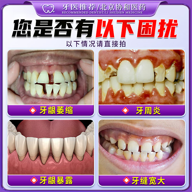 北京协和医学院萎缩牙龈i牙膏修复再生牙根外露专用牙膏护龈固齿牙龈i萎缩再生 【牙龈萎缩牙膏】一盒 舒适达牙龈修复萎缩抗过敏松动
