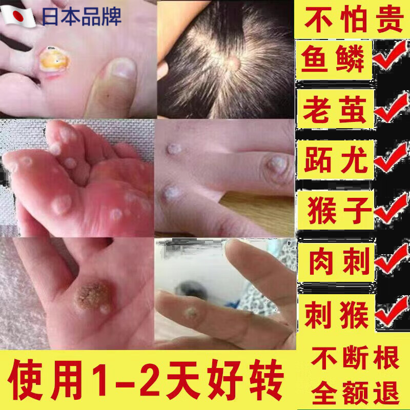 祛去猴子的药肉粒疙瘩鱼鳞痣治瘊子药脚肉刺猴专用药手部 50ml 祛去