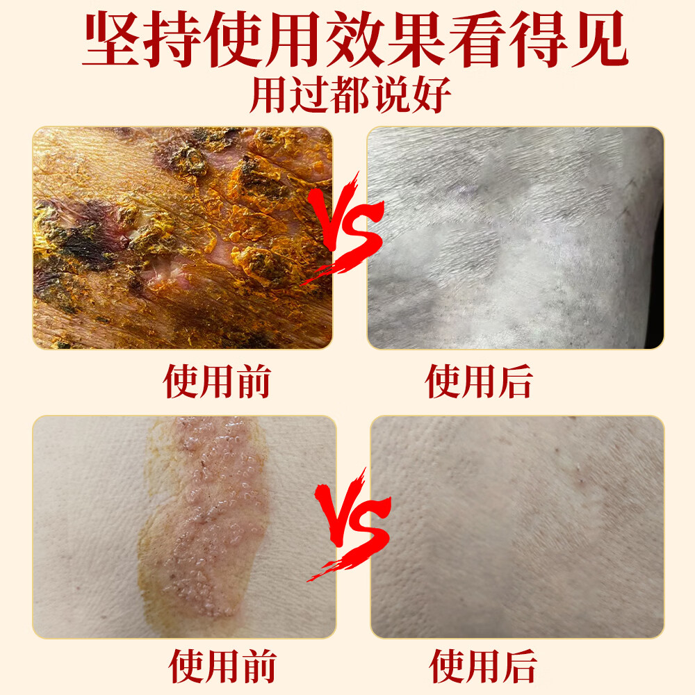 健霖医用创面护理软膏带状疱疹瘙痒缠腰水泡密集蛇缠腰蛇盘疮飞龙 一盒(初期)