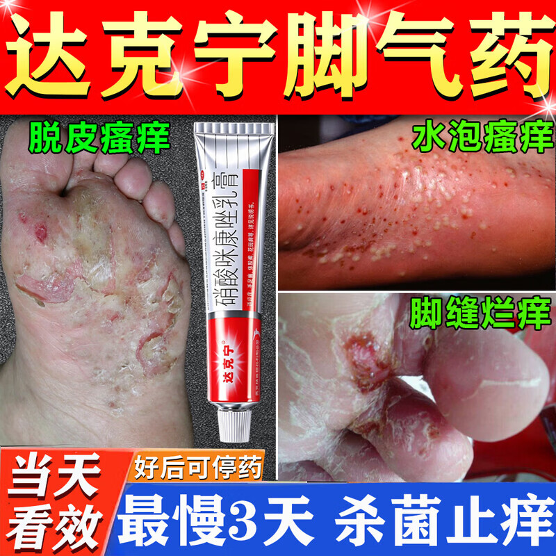 [达克宁]硝酸咪康唑乳膏 治脚气药止痒脱皮烂脚丫真菌感染根药治真菌感染起小水泡痒脱皮药【发货特效】 2%*20g 3支装 【达克宁正品脚气膏】