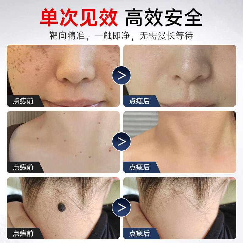 RASW德国【无痛无疤丨精准点涂】点痣笔美容院专用无痛不留疤扫斑点痣激光笔扁平疣仪器点斑消痣小白用 蓝色【强效款】电离子碳化丨无痛不留疤 【红蓝光护肤丨芯片升级丨超长续航】