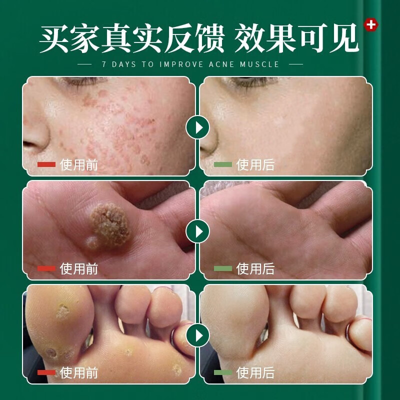 南京同仁堂扁平i疣搭咪喹莫l特乳膏hpv面部丝疣寻常i疣去脖子疣瘊净跖