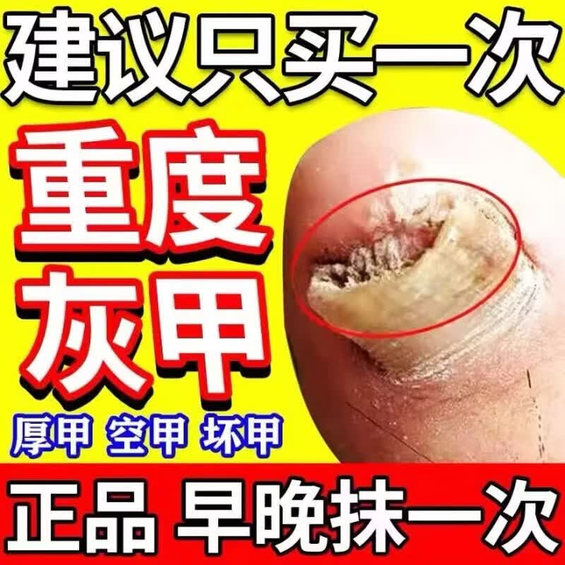 国药药材重度灰指(趾)甲专用指甲增厚发黄变厚真菌感染灰甲净抑菌液 三盒装【2-5个灰甲】 灰指甲100%特效专用的药第一名 京东折扣/优惠券