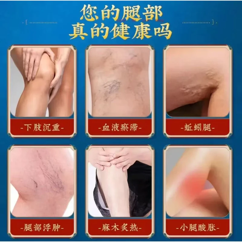 内廷上用堂静脉曲张退热凝胶药膏蚯蚓腿腿部血管变形腿疼酸麻肿胀 1个*1盒 【初期调理】
