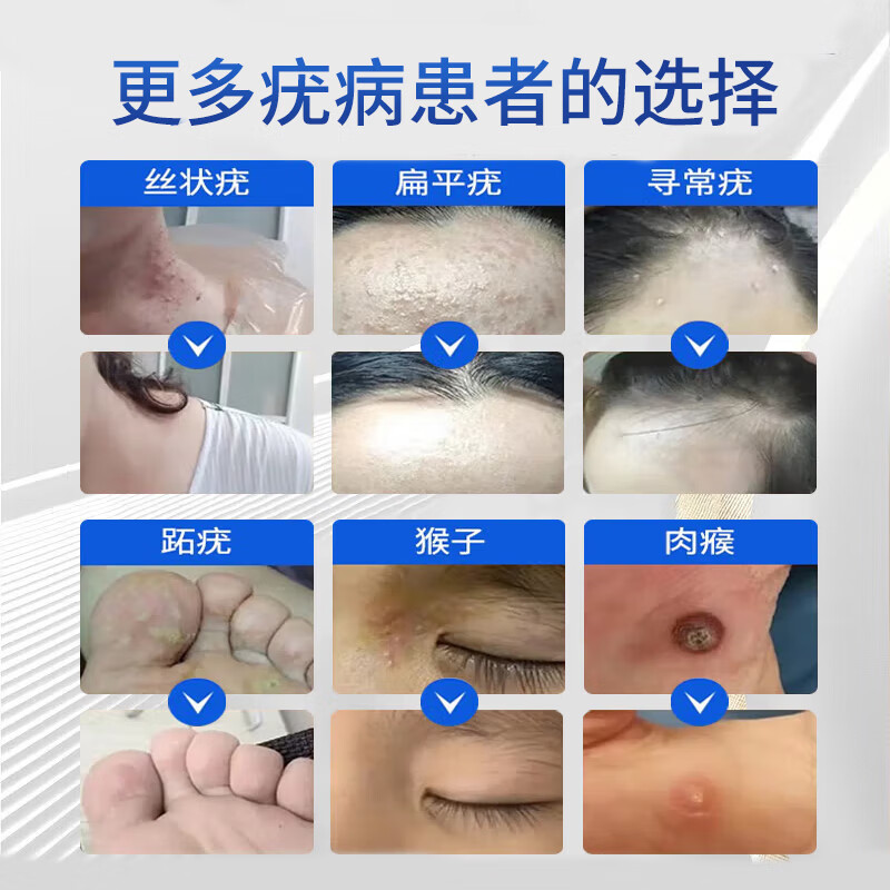 雪槐去尤灵偏平尤面部药专用脖子瘊子去丝状尤体尖锐湿尤跖尤祛尤膏 瘊尤膏 20g 2盒