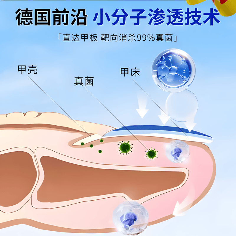 SOS德国sos原装进口灰指甲笔SOS指甲液根坏烂甲外用专用特强效药水 特效1盒【体验装】
