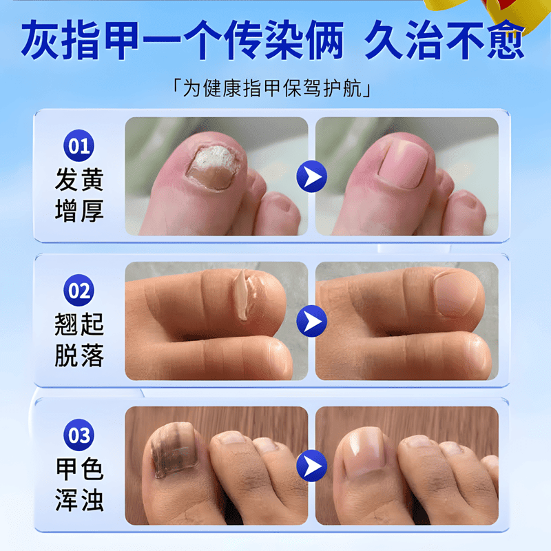 德国灰指甲笔德国进口指甲笔喷雾水指甲笔外用原装进口0td 1支【德国进口】 品牌直售