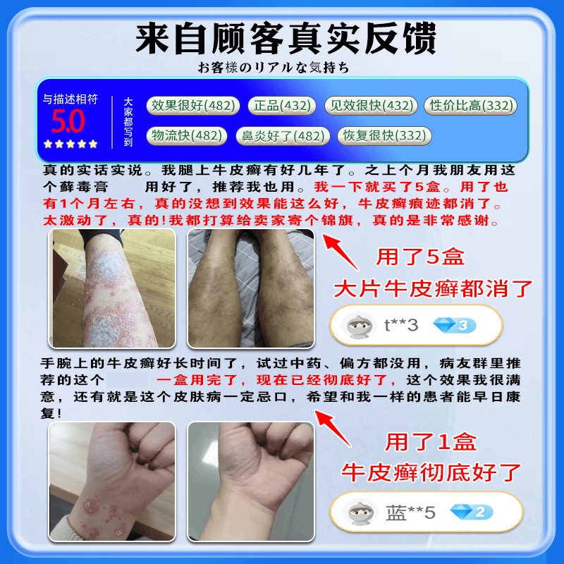 岩井昃弘牛皮癣断根药皮肤癣膏药真菌止痒抑菌皮肤顽固牛皮癣膏药进口 买三送二【好后不会反复】真菌王 银屑病牛皮癣皮肤癣专用特强效膏