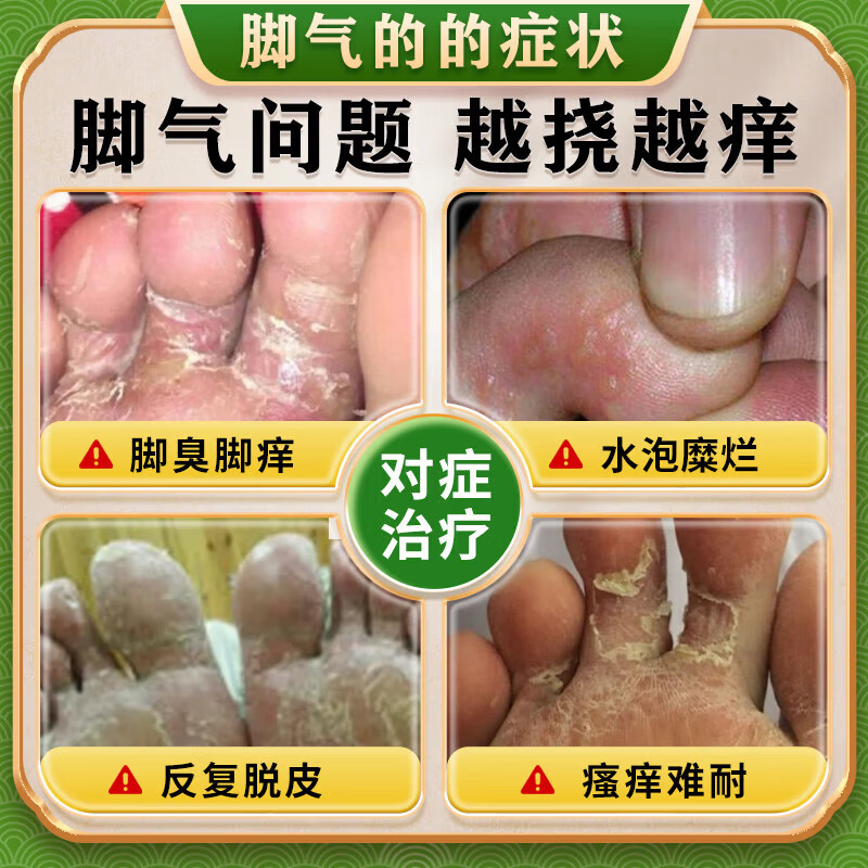[嘉效]盐酸特比萘芬乳膏 1%*25g 2盒装 真菌感染等抗真菌药脚气药治疗止痒脱皮烂脚丫真菌感染根源治起小水泡痒特强效药 疗程装 脚底水泡脱皮