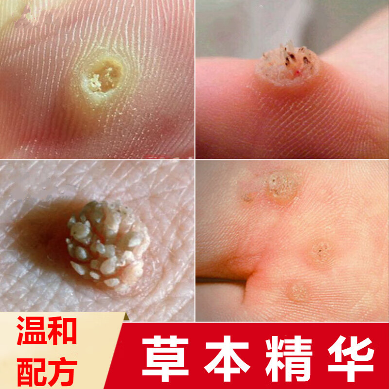 k&p猴子去除清i疣液去脖子小肉粒一抹无忧神器丝状i疣猴偏方跖i疣刺