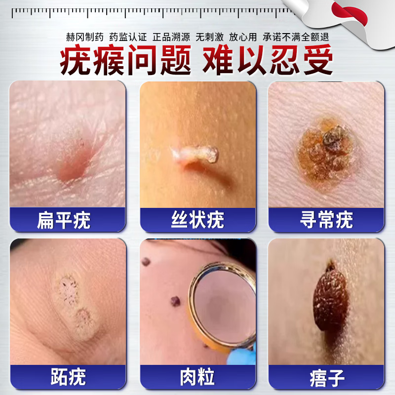 制药克疣膏去身体肉粒疙瘩跖疣扁平丝状疣颈部脖子上小肉粒药扁平疣药 日本进口去i疣神器祛疣灵】一盒 hpv疣体脱落膏祛疣膏去i疣膏药