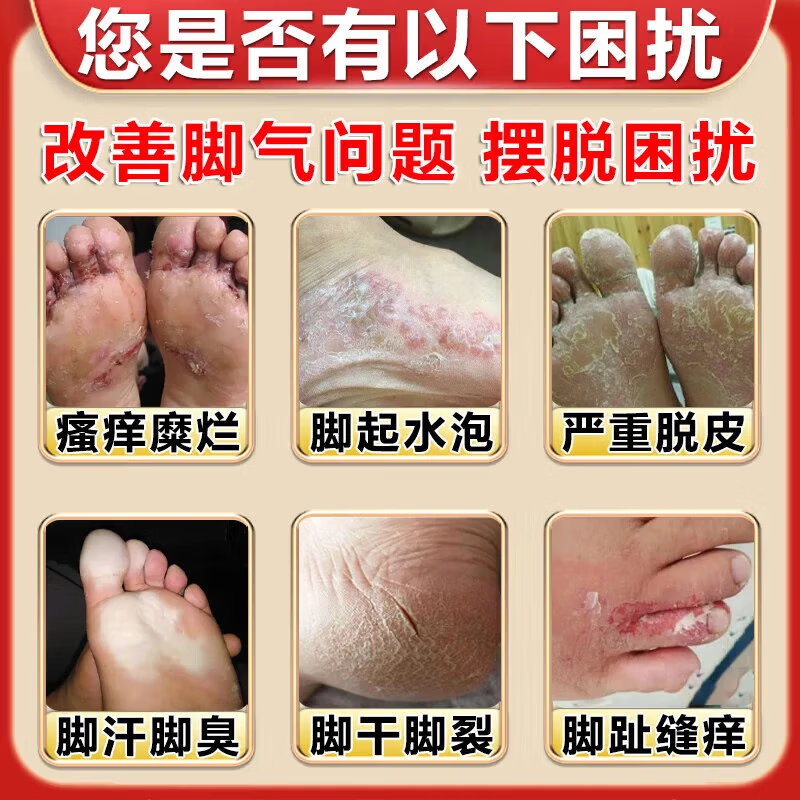 [达克宁]硝酸咪康唑乳膏 治脚气药止痒脱皮烂脚丫真菌感染根药治真菌感染起小水泡痒脱皮药(发货特效) 2%*20g 1盒装 【多盒优惠推荐】