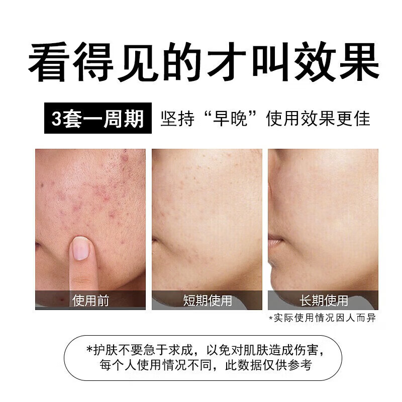 正彩15%壬二酸凝胶和水杨酸面霜细致毛孔霜淡化痘印黑头粉刺面霜套装 15%壬二酸+水杨酸组合*2