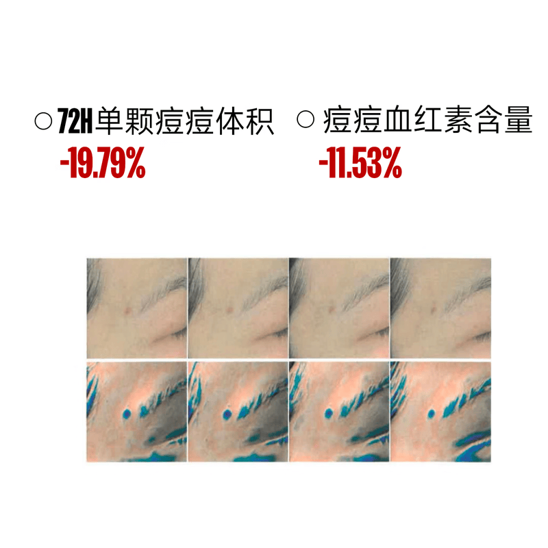 芙芙净痘修红微晶焕肤精华液改善痘肌凝胶祛痘膏面部护肤品生日礼物女 祛痘精华20g+日贴+夜贴
