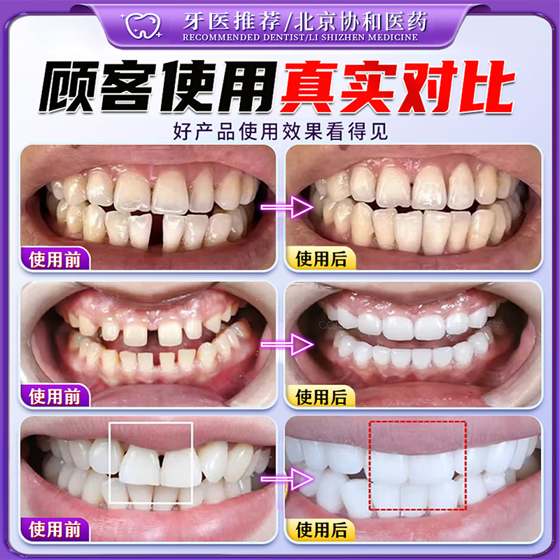 北京协和医学院萎缩牙龈i牙膏修复再生牙根外露专用牙膏护龈固齿牙龈i萎缩再生 【牙龈萎缩牙膏】一盒 舒适达牙龈修复萎缩抗过敏松动