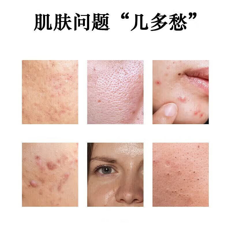 正彩15%壬二酸凝胶和水杨酸面霜细致毛孔霜淡化痘印黑头粉刺面霜套装 15%壬二酸+水杨酸组合*2