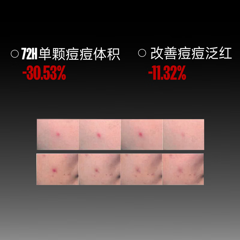 芙芙净痘修红微晶焕肤精华液改善痘肌凝胶祛痘膏面部护肤品生日礼物女 祛痘精华20g+日贴+夜贴