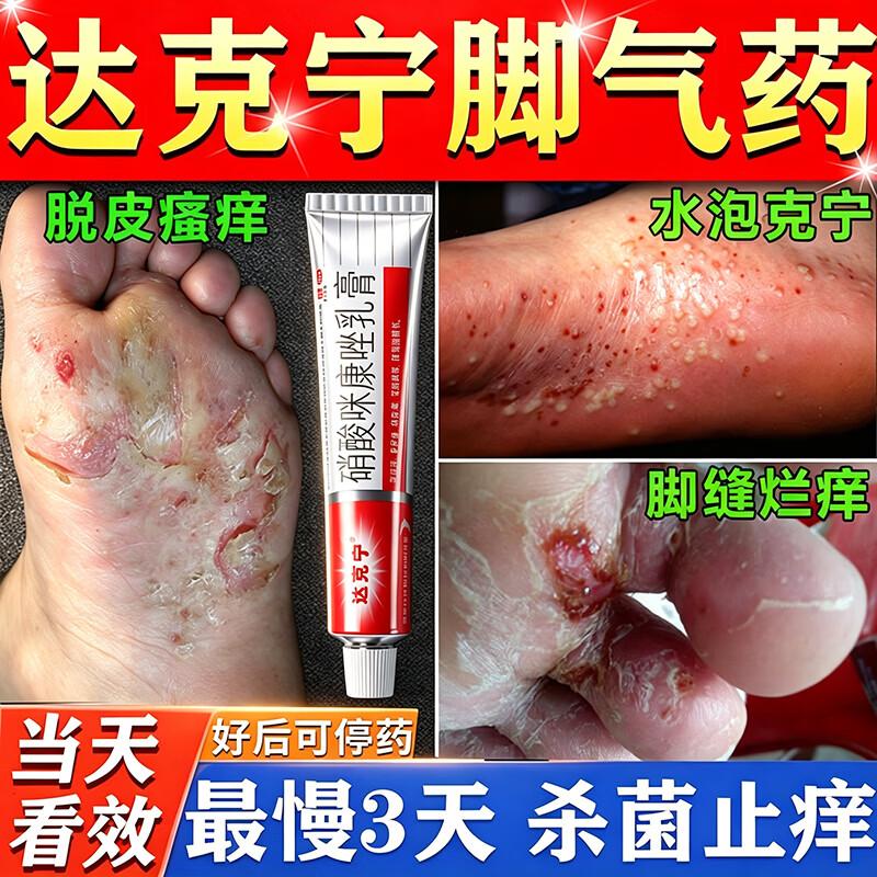 [达克宁]硝酸咪康唑乳膏 治脚气药止痒脱皮烂脚丫真菌感染根药治真菌感染起小水泡痒脱皮药(发货特效) 2%*20g 1盒装 【多盒优惠推荐】
