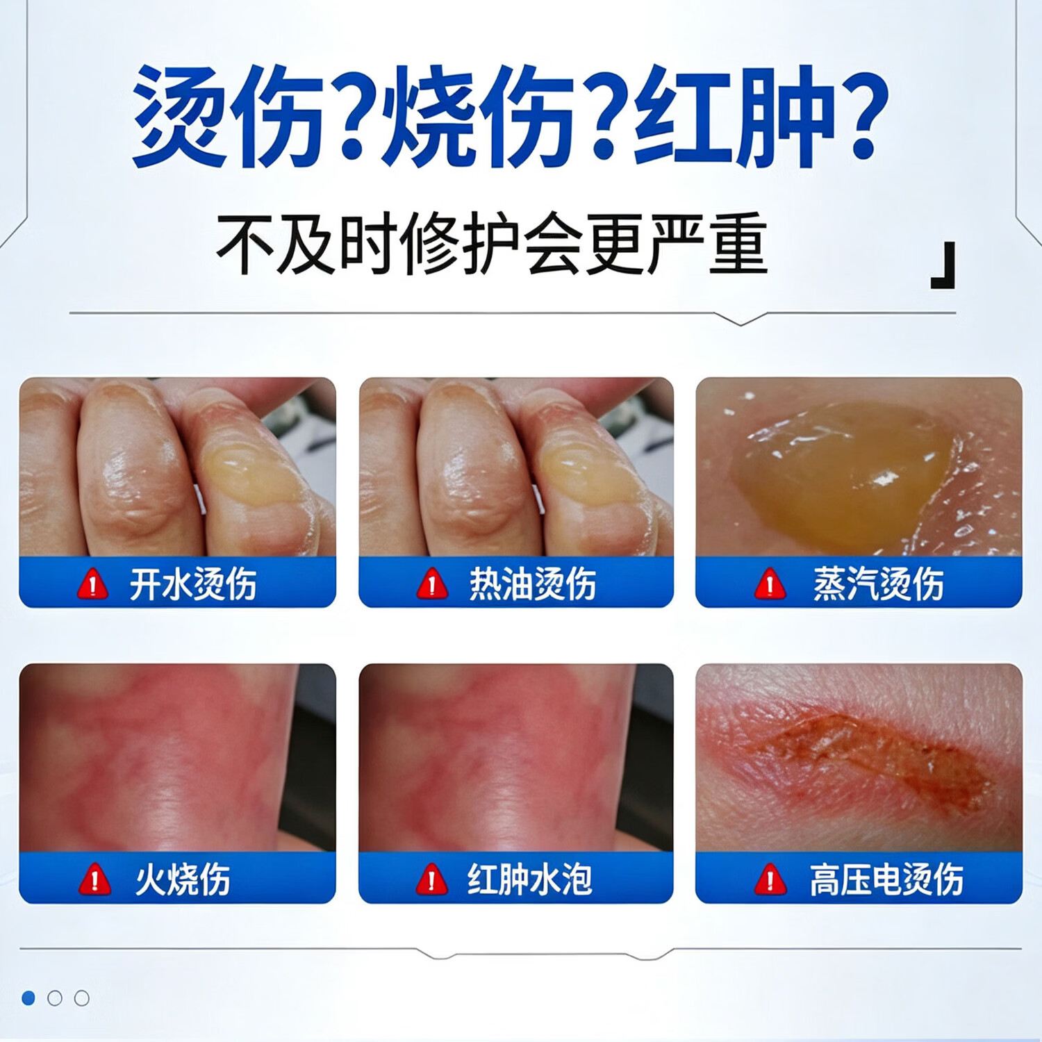 魏老爷重组胶原蛋白烧伤烫伤修复凝胶修护凝胶 【囤货家庭装】5支装