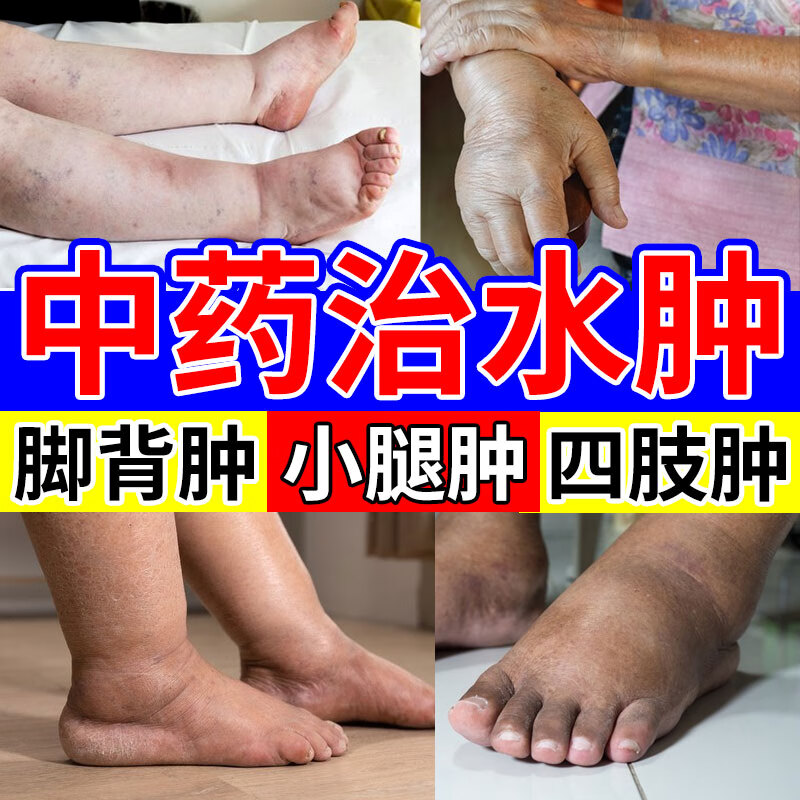 去水肿利尿消水肿药 水肿消除脸部浮肿眼皮浮肿脚背浮肿腿部水肿手肿