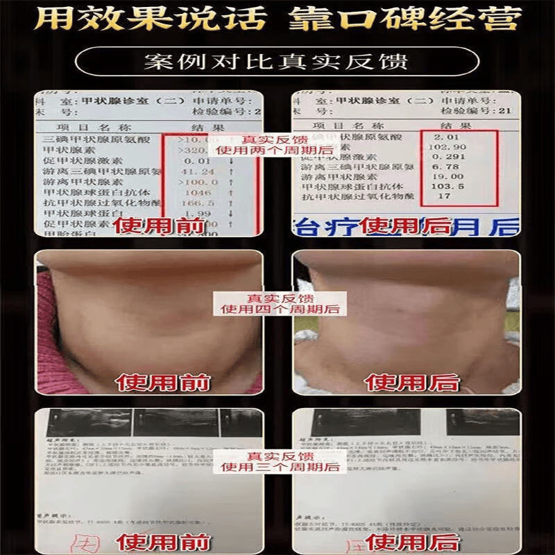 觅食天下夏枯草蒲公英散结茶消除甲状腺乳腺结节淋巴肺结节茶猫爪草散结汤 20包*1袋 【夏枯草蒲公英郁金猫爪草】5副