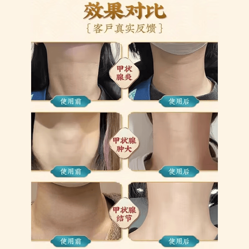 觅食天下夏枯草蒲公英散结茶消除甲状腺乳腺结节淋巴肺结节茶猫爪草散结汤 20包*1袋 【夏枯草蒲公英郁金猫爪草】5副